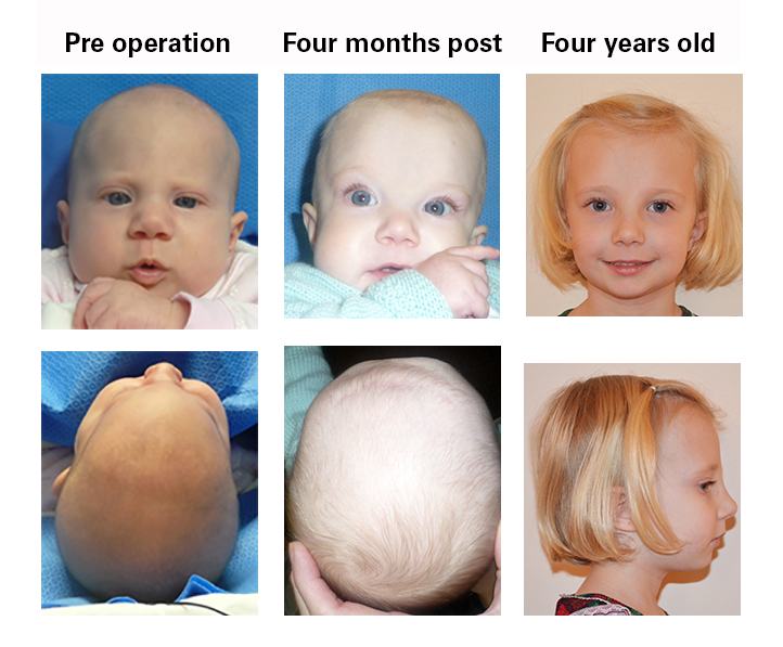 Metopic craniosynostosis patient