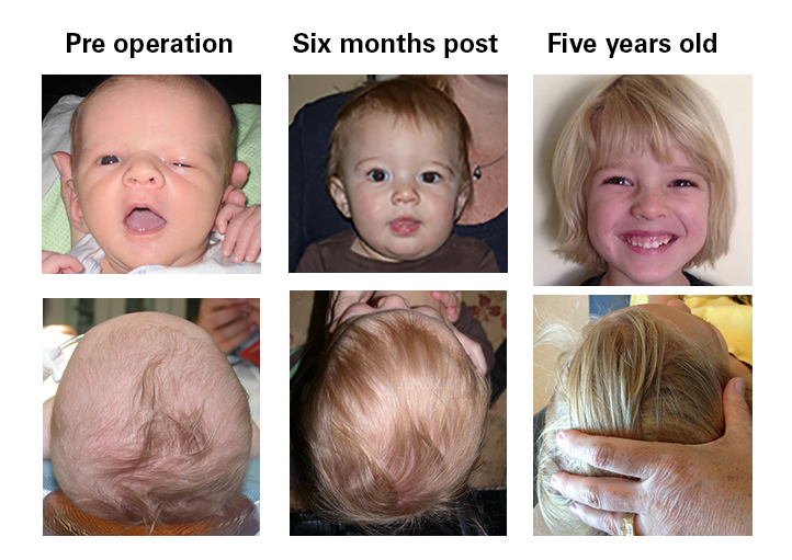 Coronal craniosynostosis patient