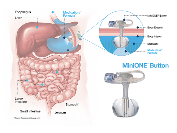 Illustration of where g-tube is placed